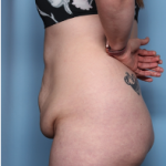 Body Lift Before & After Patient #34335